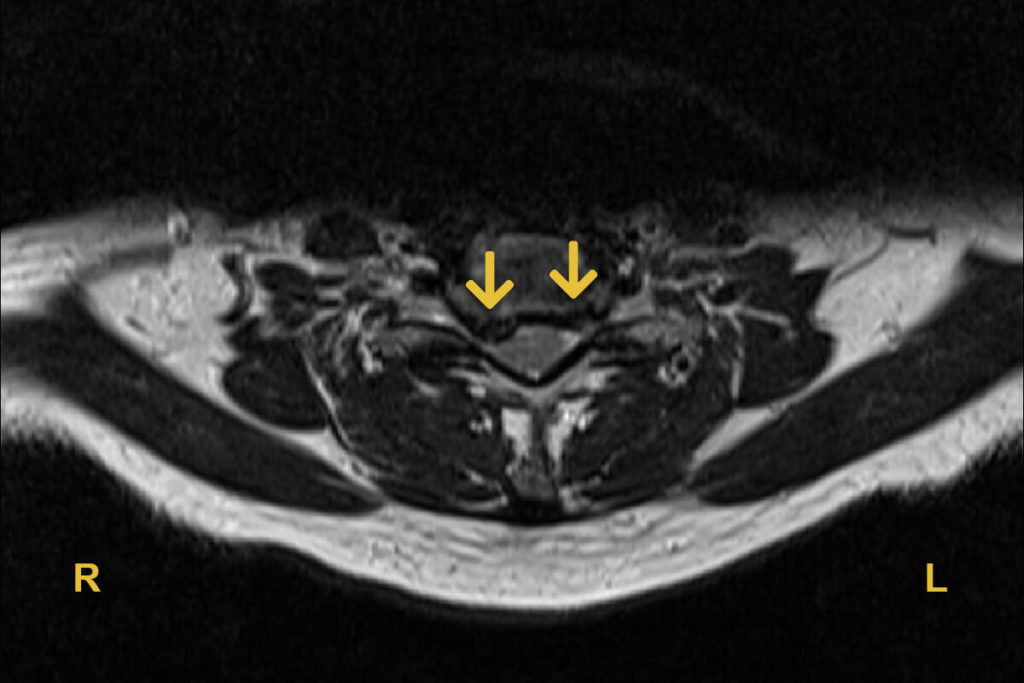 Halswirbelsäule Cervicalstenose Foramenstenose Spinalkanalstenose