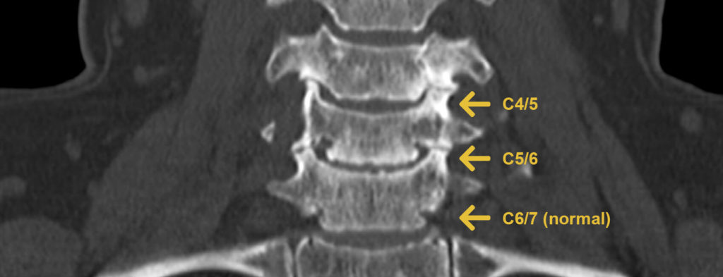 Halswirbelsäule Cervicalstenose Foramenstenose Spinalkanalstenose