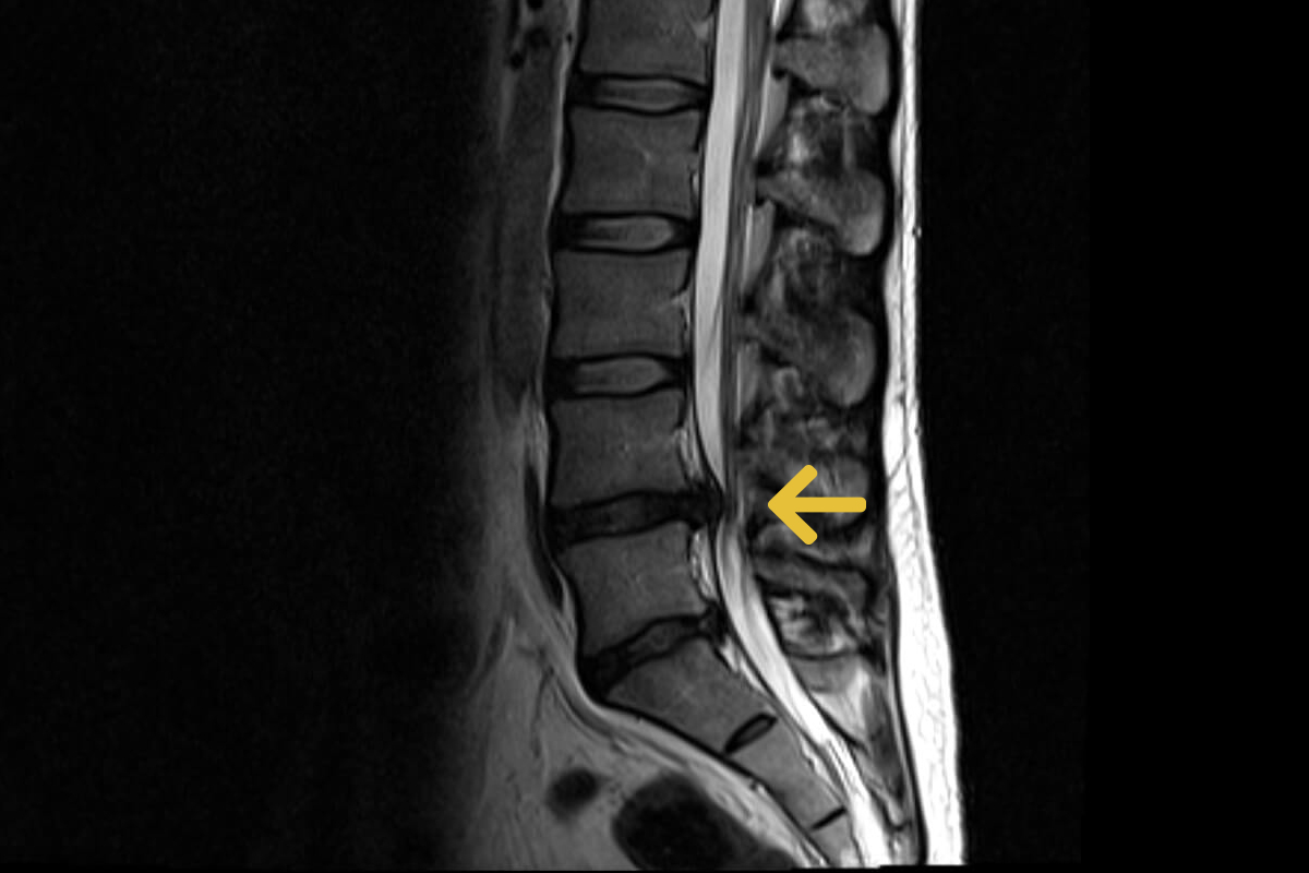 Bandscheibenvorfall Gemeinschaftspraxis für Neurochirurgie