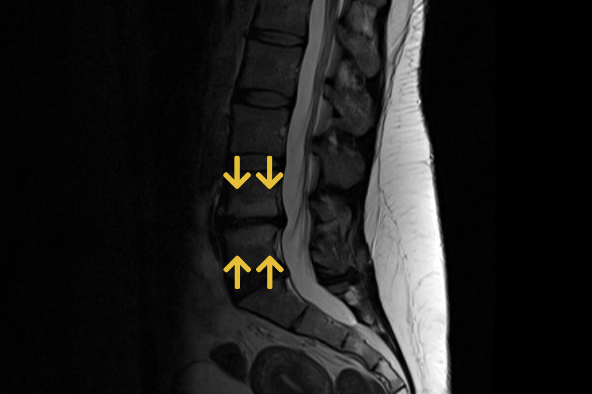 Osteochondrose Lwk 5 Swk 1 www.neurochirurgie-offenbach.de