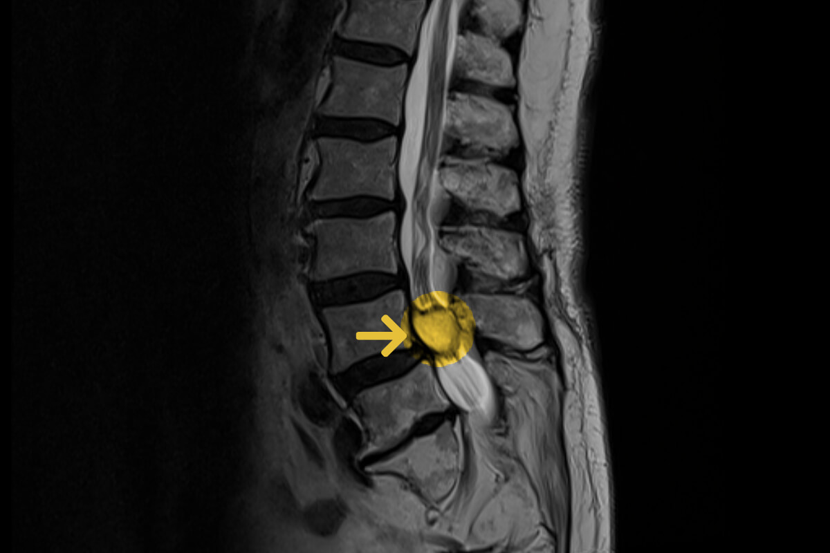 Zyste An Der Wirbelsäule Symptome www.neurochirurgie-offenbach.de